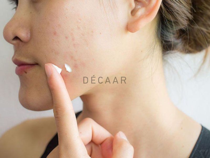 trị mụn trứng cá bọc nhanh nhất